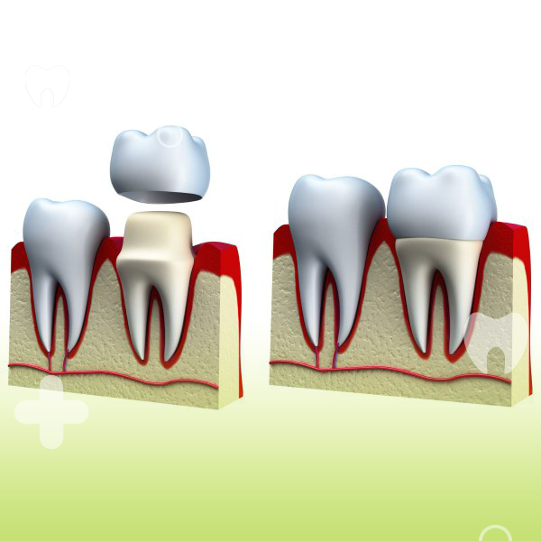تاج دندان چیست؟